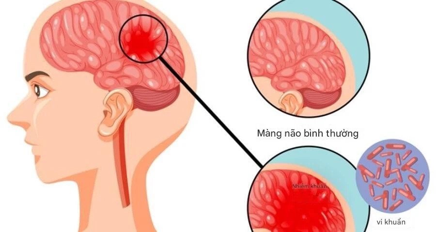 TPHCM ghi nhận ca não mô cầu mới, trẻ đã tiêm vaccine vẫn mắc bịnh